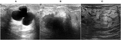 Breast Cancer Detection and Classification Empowered With Transfer Learning